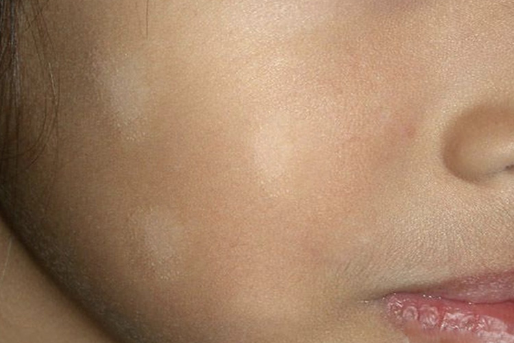 面部的白色糠疹图