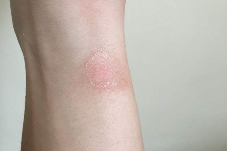 手臂癣鳞屑图 手臂癣鳞屑图