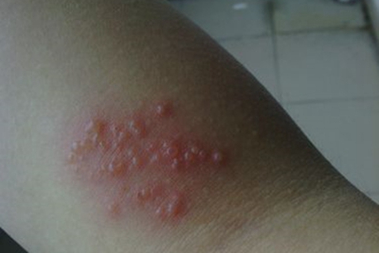 铜绿假单胞菌毛囊炎小水疱图