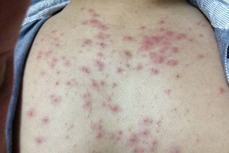 成人脂溢性皮炎胸部症状图