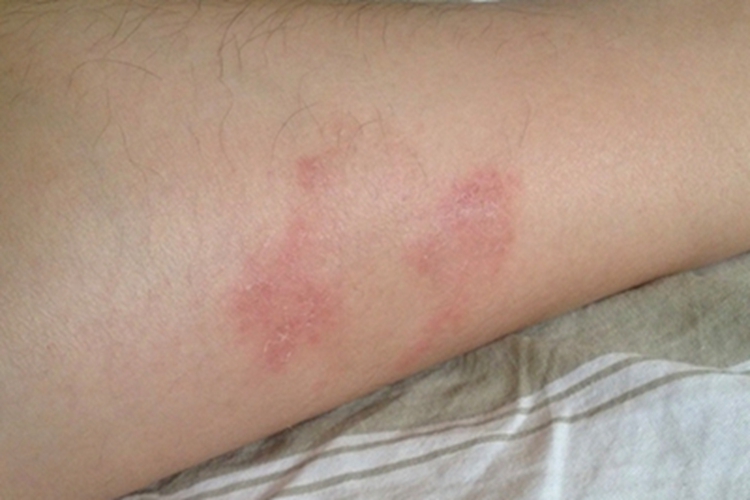 红癣小腿症状图 红癣小腿症状图