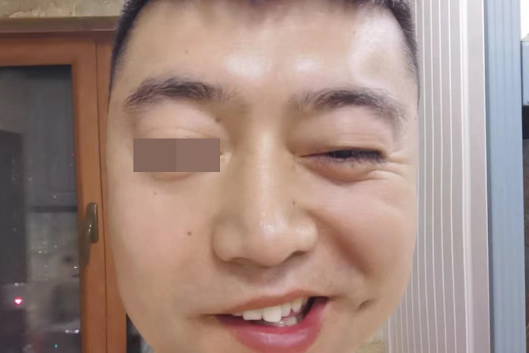 周围性面神经麻痹图