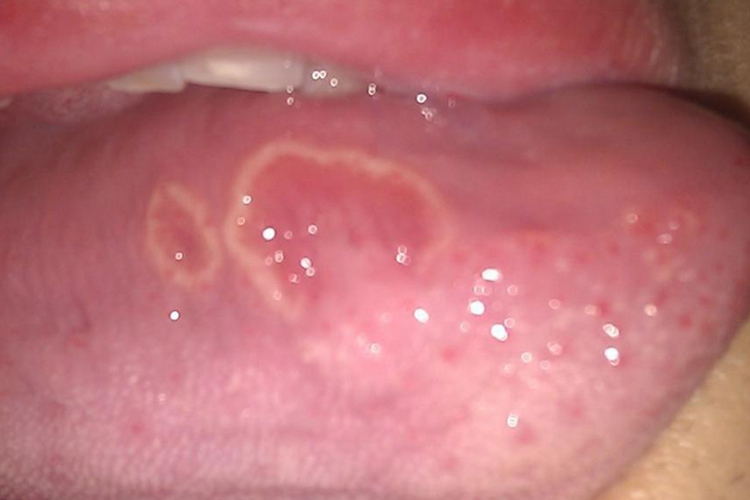 两岁宝宝重型阿弗他溃疡图