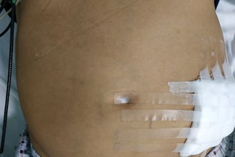 肝癌晚期腹水腹部肿胀图 肝癌晚期腹水腹部肿胀图