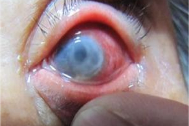 匐行性角膜溃疡眼部白斑图
