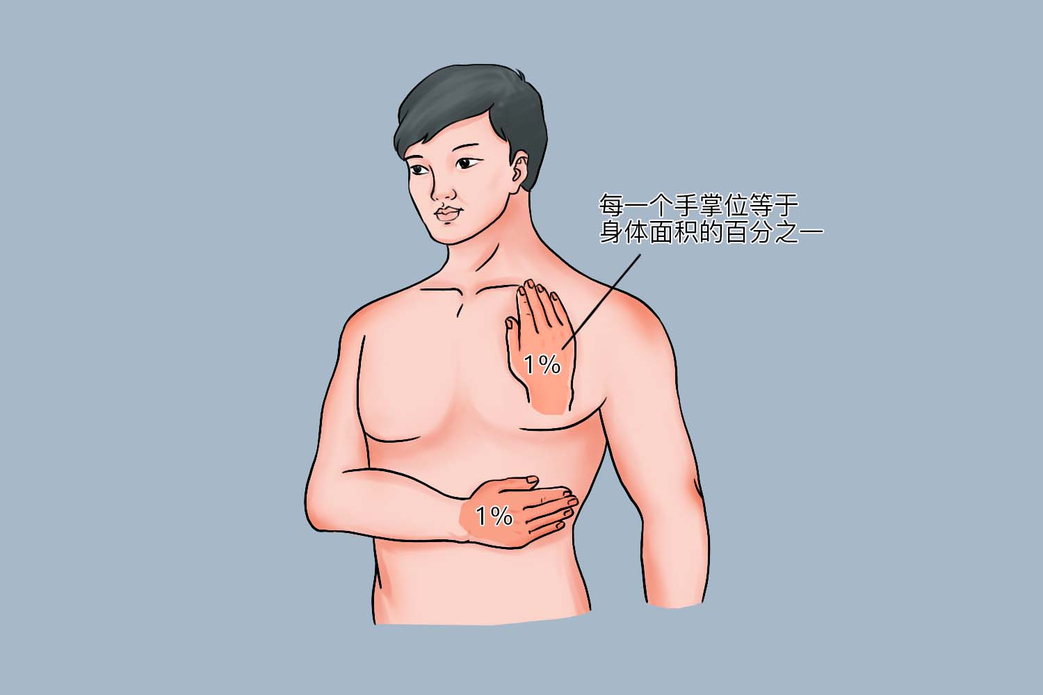 烧伤面积估算手掌法图