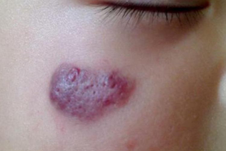 毛细血管瘤面部症状图 毛细血管瘤面部症状图