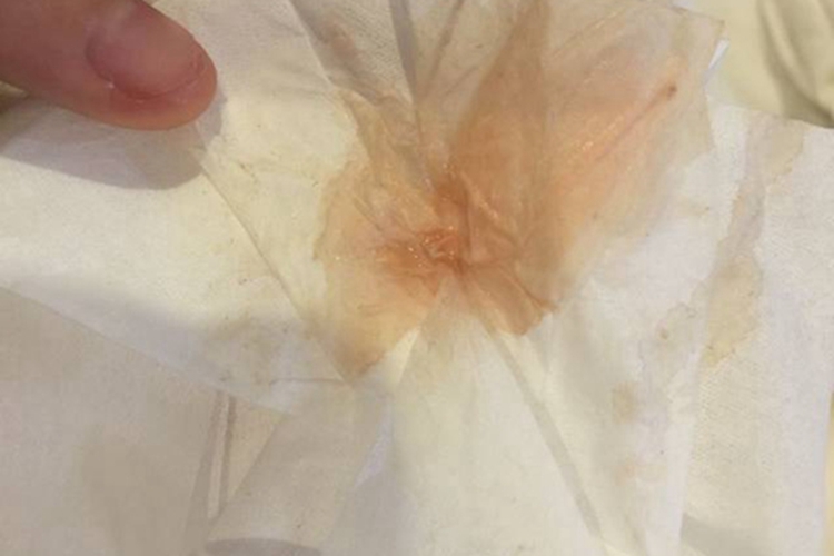 孕中期淡粉色分泌物图