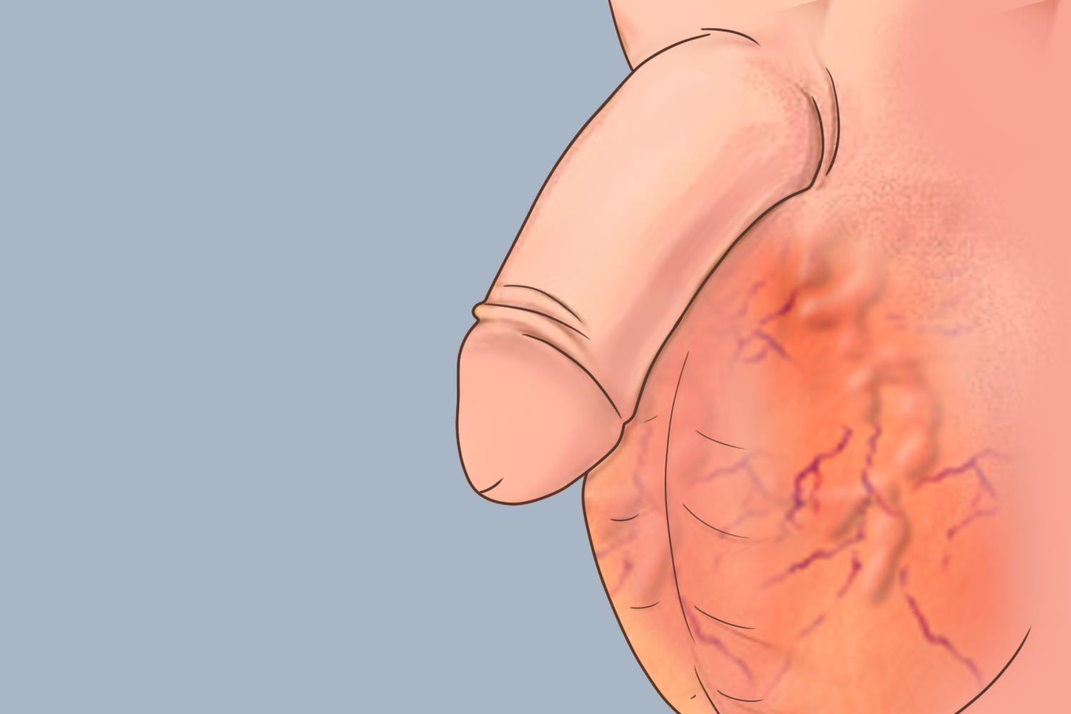 精索静脉曲张图