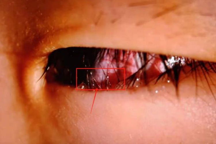 下睫毛倒睫结膜充血图