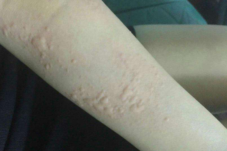 风寒荨麻疹症状图