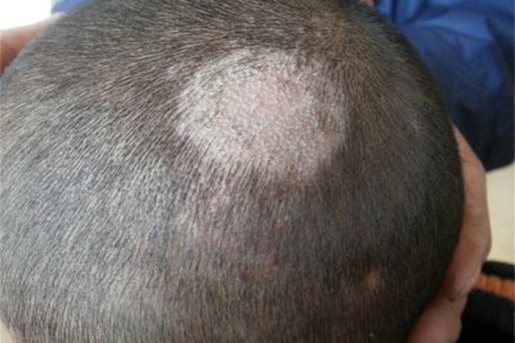 白癣头顶出现大块白斑图