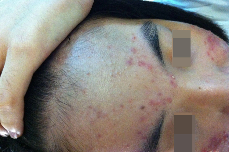 马拉色菌脸部感染丘疹图