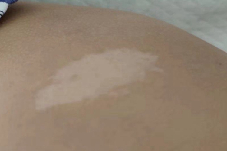 结节性硬化症腹部白斑图 结节性硬化症腹部白斑图