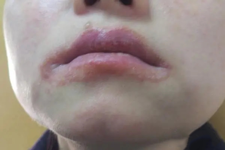 嘴巴过敏丘疹水疱图 嘴巴过敏丘疹水疱图
