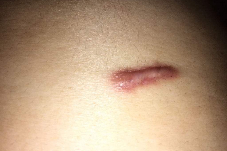 胆结石微创手术伤疤图