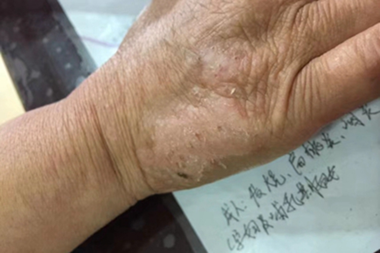 慢性湿疹手部脱屑图 慢性湿疹手部脱屑图