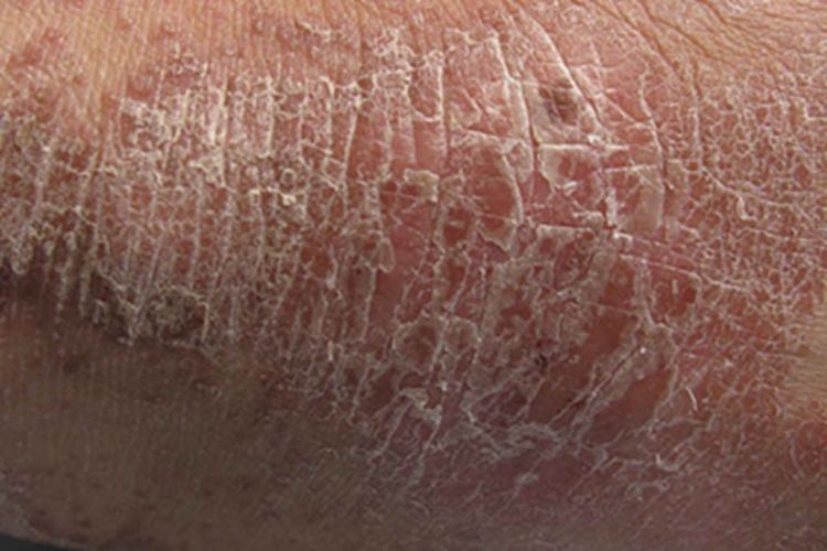 毛发红糠疹脚后跟脱屑图 毛发红糠疹脚后跟脱屑图