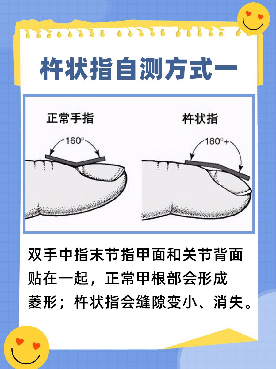 揭秘假性杵状指，别让手指变形吓到你！