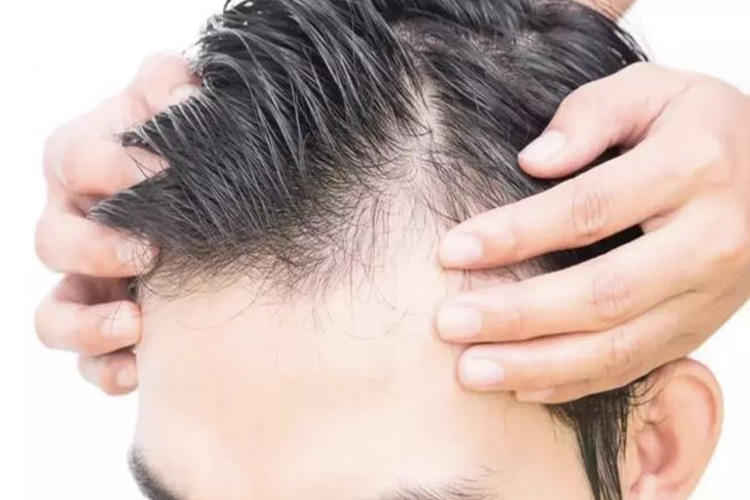 男性脂溢性脱发Ⅱ级图 男性脂溢性脱发Ⅱ级图