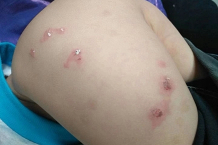 丘疹性荨麻疹大腿症状图 丘疹性荨麻疹大腿症状图