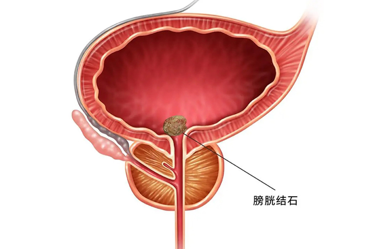 尿结石在什么位置图片图片