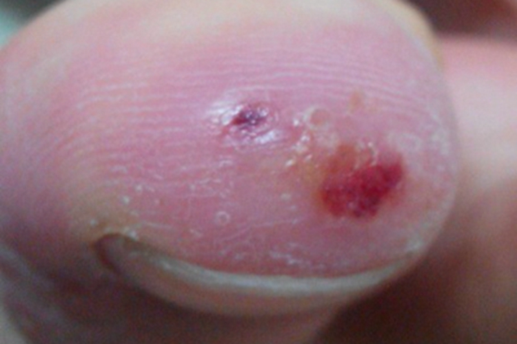 脚趾长水疱有血痂图 脚趾长水疱有血痂图