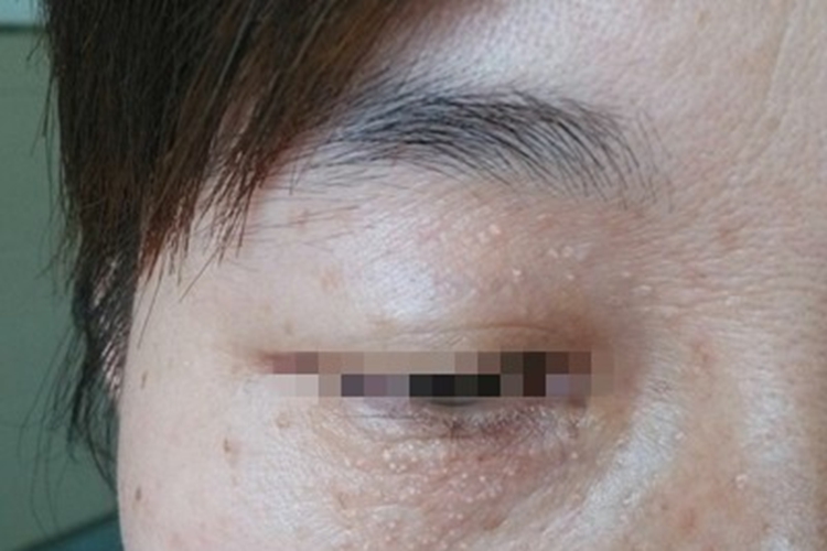 原发性粟丘疹眼周症状图