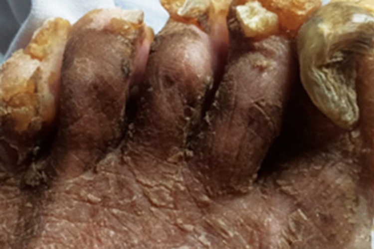 后天性厚甲症脚趾甲变形增厚图