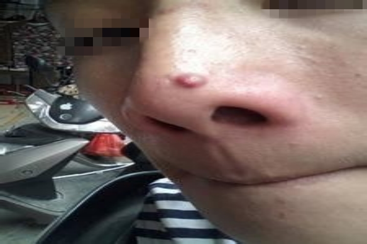 皮脂腺囊肿图 皮脂腺囊肿图