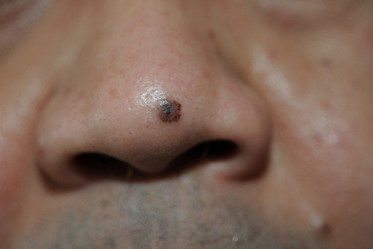 鼻子基底细胞癌早期图