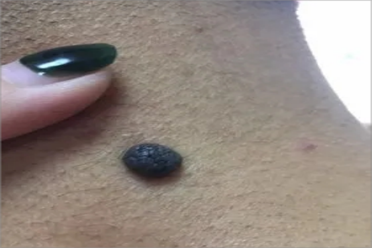 恶性黑色素瘤颈部结节图 恶性黑色素瘤颈部结节图