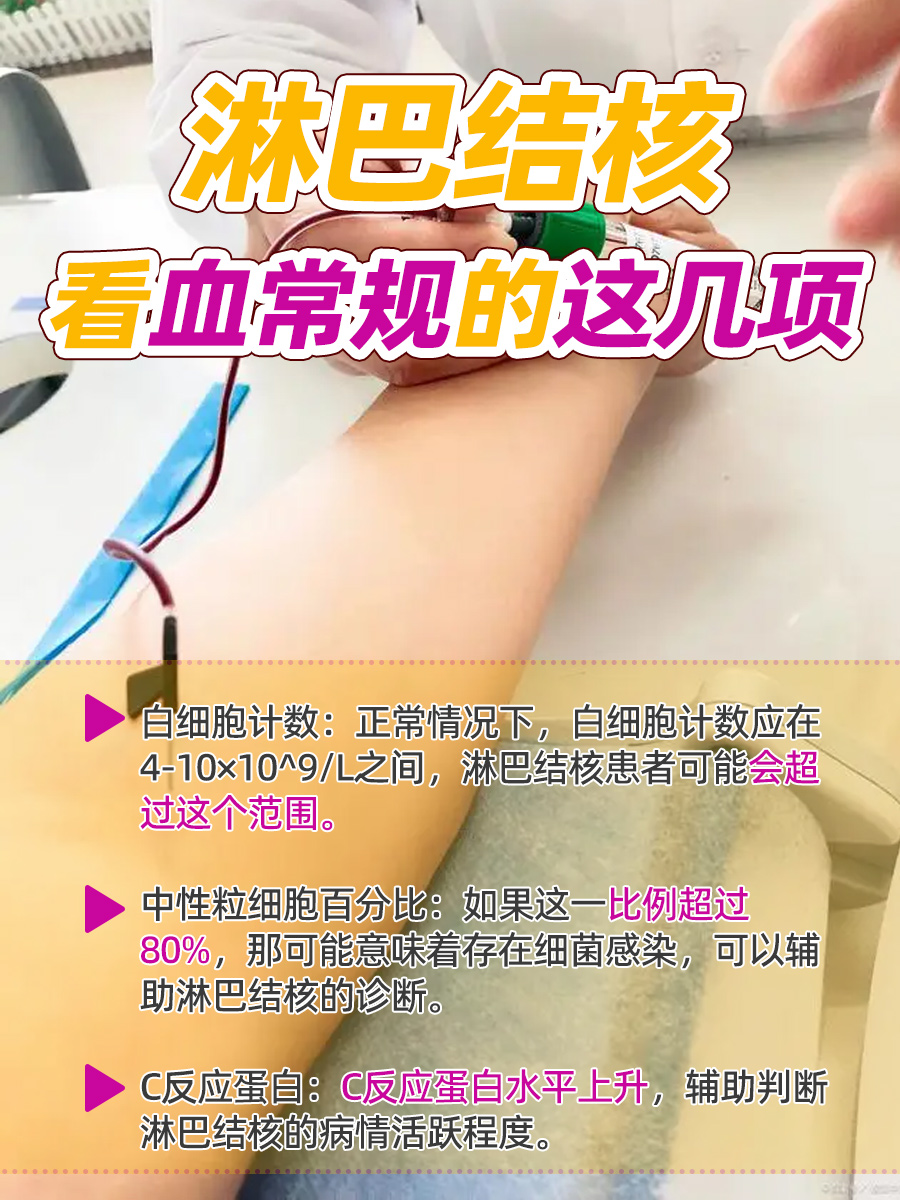 淋巴结核?血常规这几项异常要留意