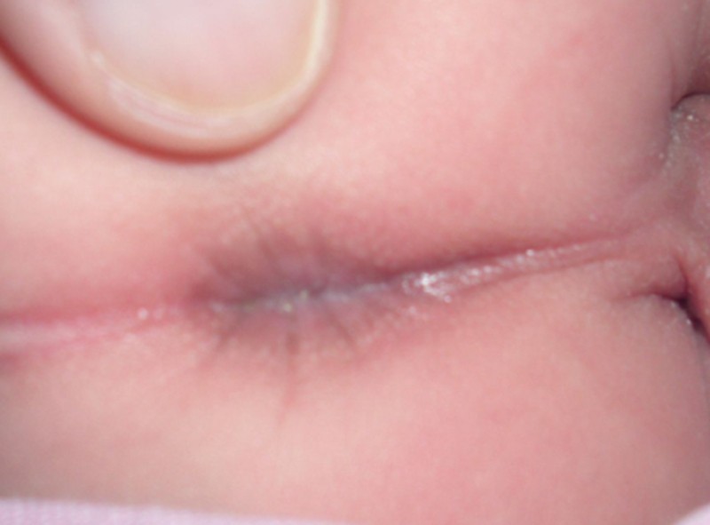 肛门湿疹的最初症状图片