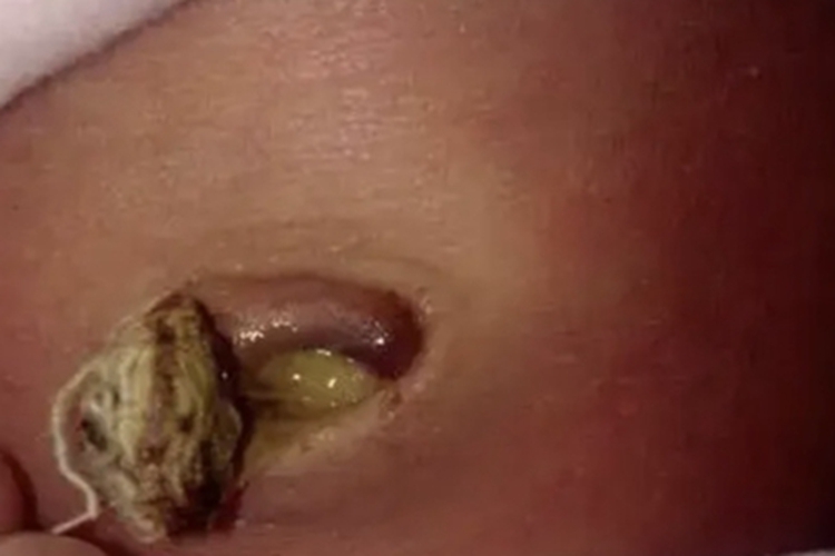 脐炎肚脐结痂图 脐炎肚脐结痂图