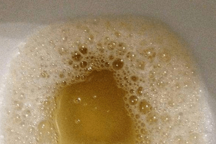 肝火小便发黄图