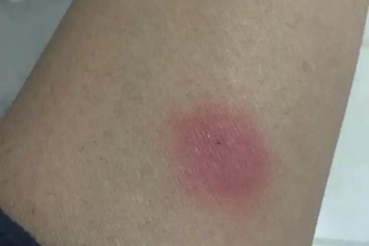 罗阿丝虫病胳膊红肿图