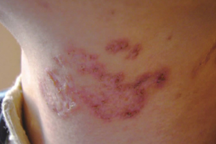 匍行性穿通性弹力纤维病症状图 匍行性穿通性弹力纤维病症状图