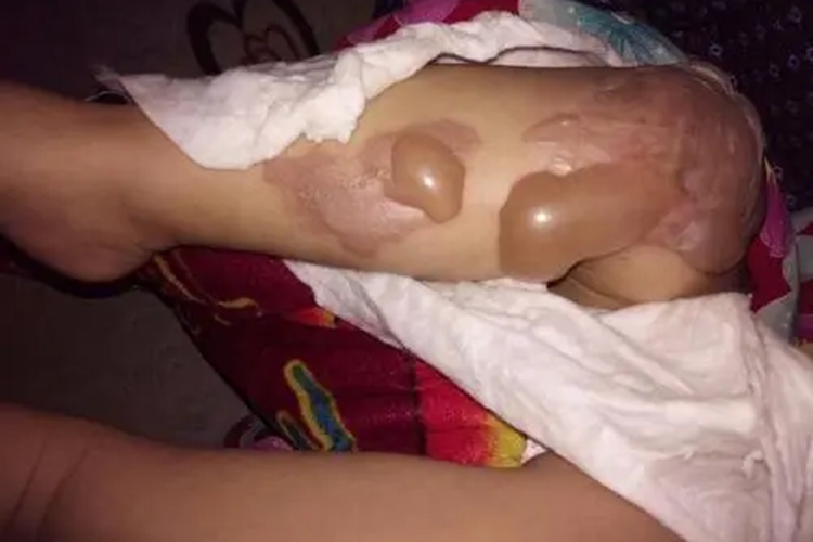 小孩开水烫伤二度起水疱图 小孩开水烫伤二度起水疱图