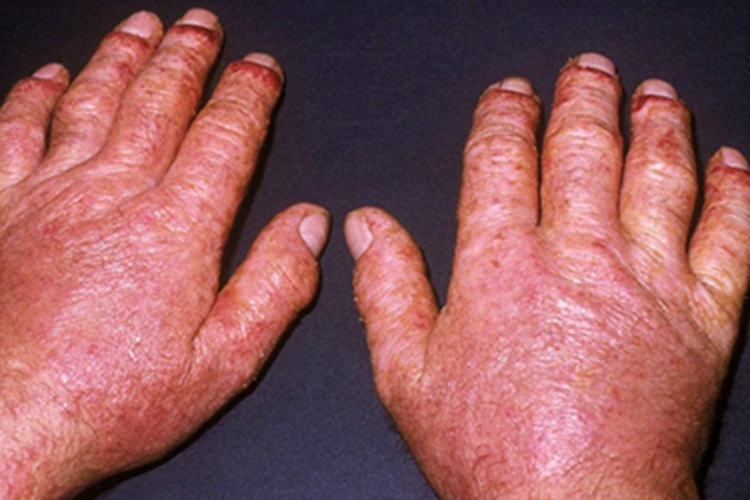 自体敏感性湿疹手背症状图