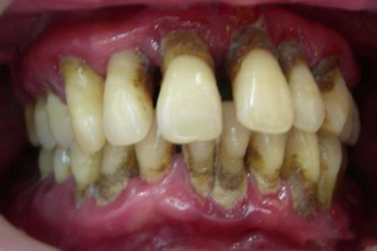 牙周炎牙肿图