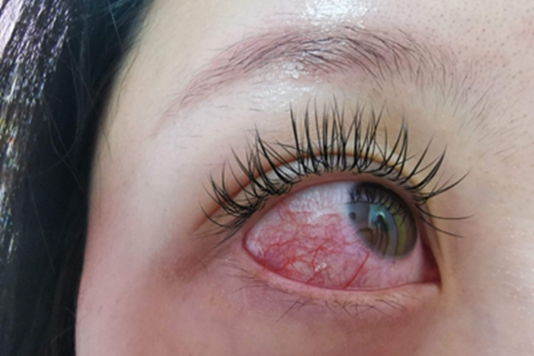 角膜软化症血丝图