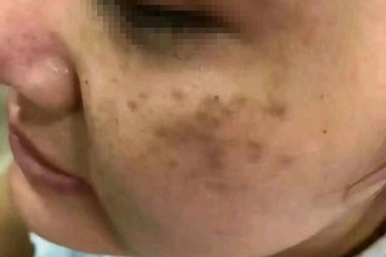 颧部褐青色痣症状图