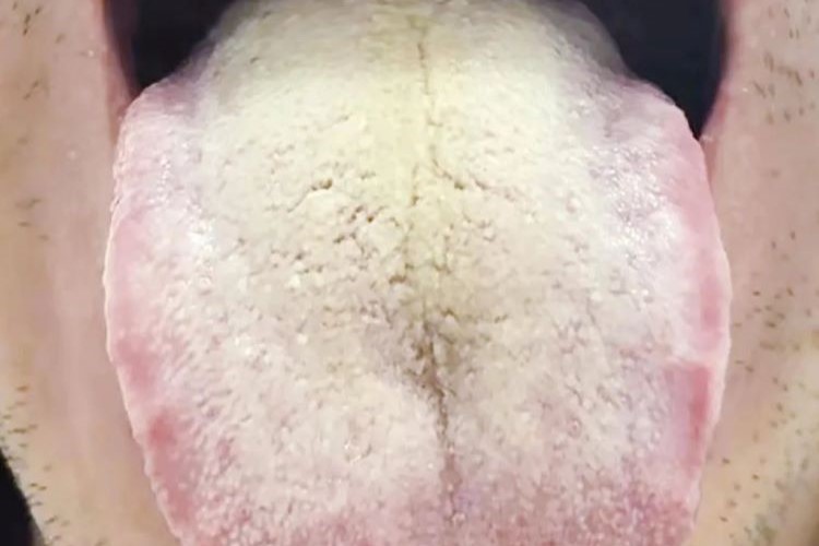 湿热体质舌苔图