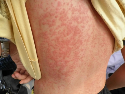 沙门菌属感染的皮肤表现后背密集疹子图