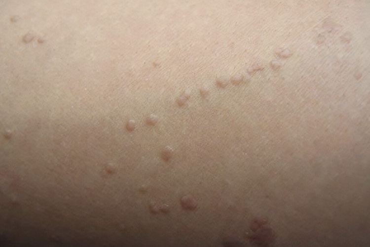 宝宝胸口扁平疣图