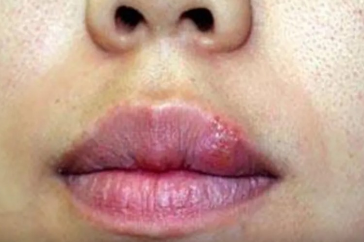 单纯疱疹嘴唇红色颗粒结痂图