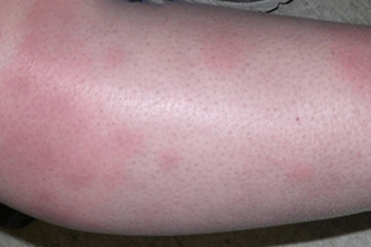 硬结性红斑小腿长红斑图