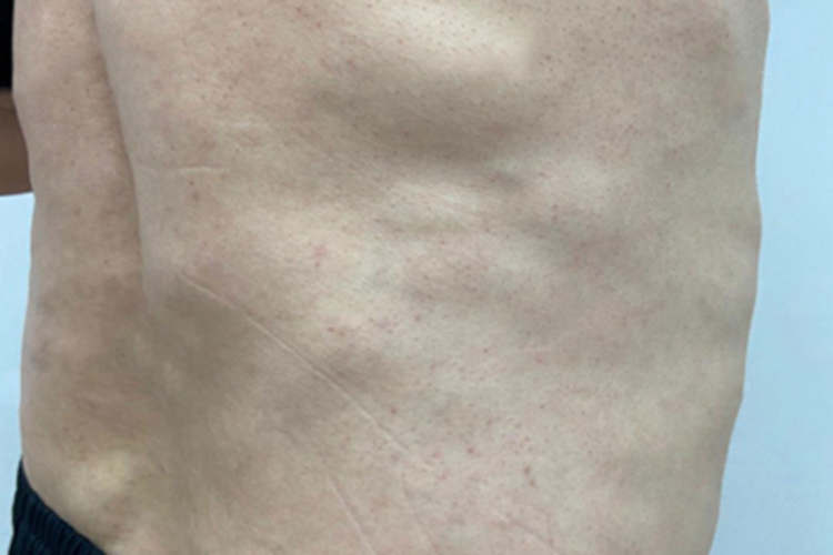 脂肪肉瘤右肋处肿块图