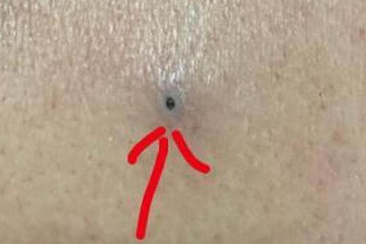 宝宝胸口皮脂腺囊肿图